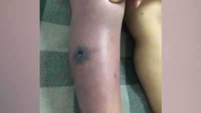 Menina de dois anos morre em Toledo e suspeita é picada de aranha